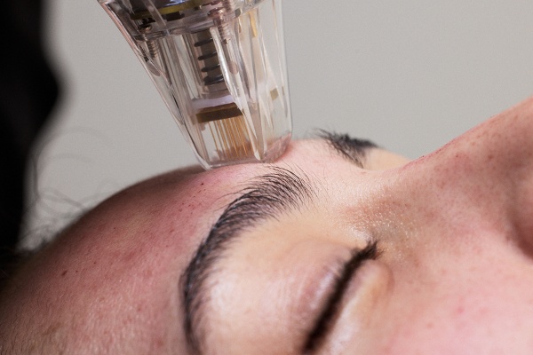 Microneedling with Radio Frequency at JECT